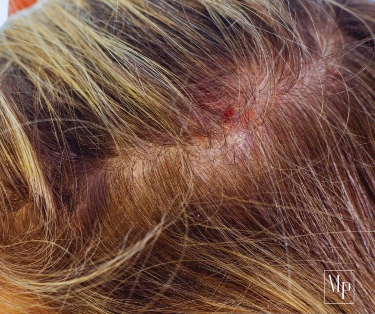 Sinais de Alergia a Progressiva: Como Identificar e Tratar – Melhores ...